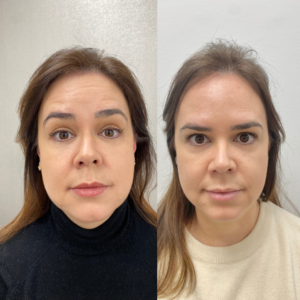 Anti-wrinkle Before & After